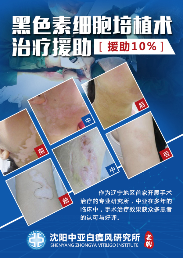 援助10%-黑色素细胞培植术治疗援助.jpg