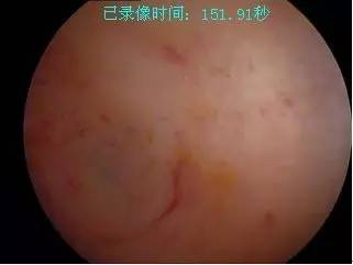 北京家恩德运医院：试管婴儿中应对子宫内膜过薄的四大战术