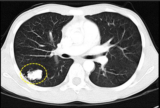 肺癌帮：肺部小结节会转成肺癌吗