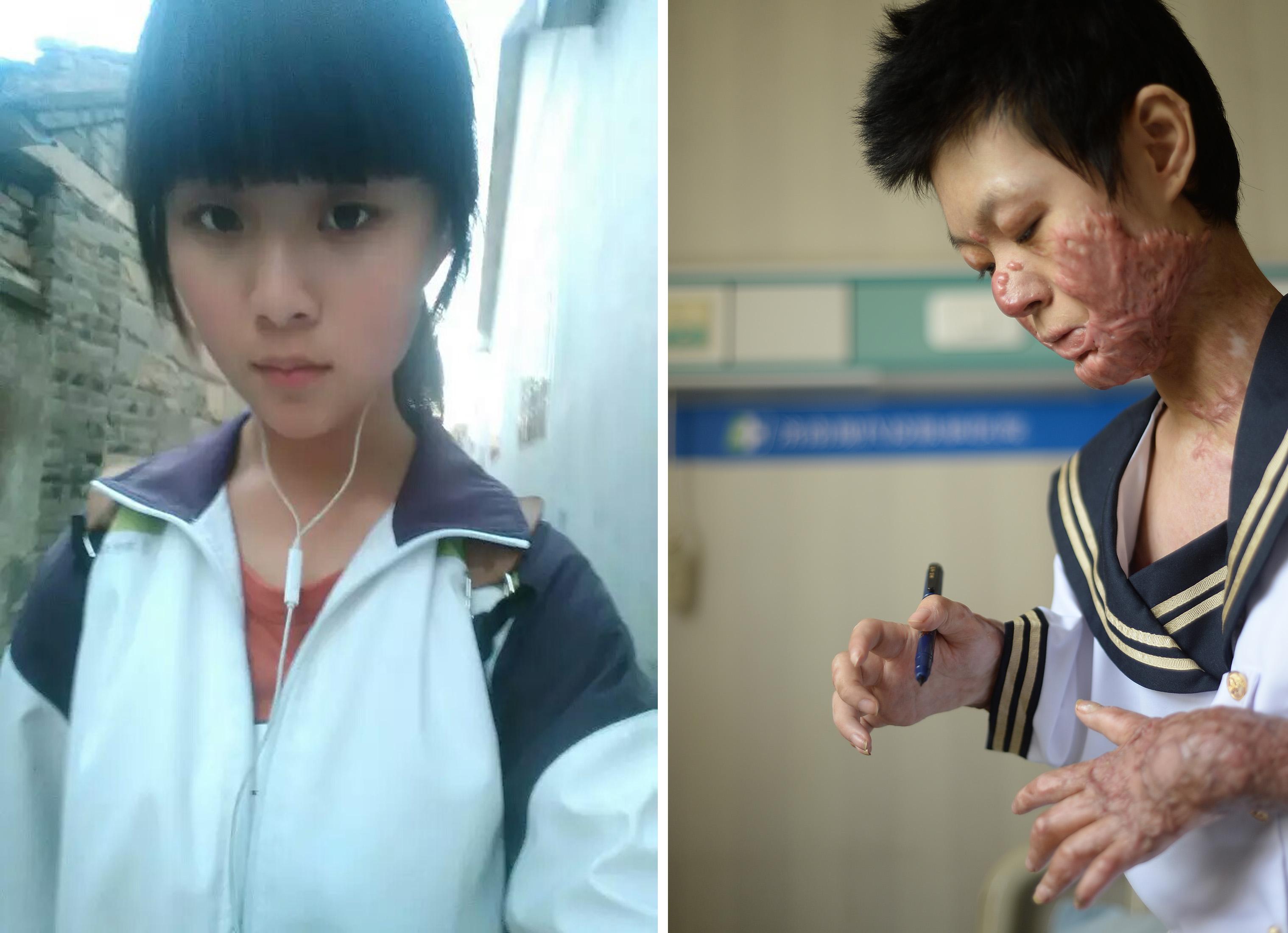 坚强最美！山东女孩做饭90%烧伤如今勇敢拍写真