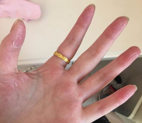 水泡型手癣怎么治疗，知道这些很快你就能痊愈