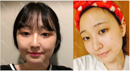 【美迪莹】去韩国做颧骨手术蜕变--追踪记录115天！