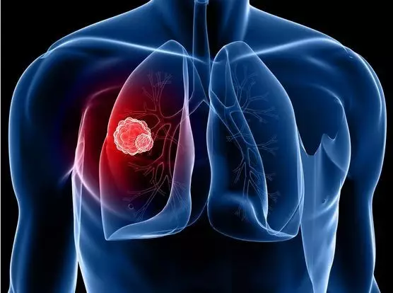 出国看病被确诊为肺癌，这几个问题帮助你更好了解病情！