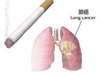 肺癌帮：为什么有人吸烟不得肺癌，这些习惯要注意